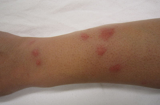 Bed Bug Control Cochrane