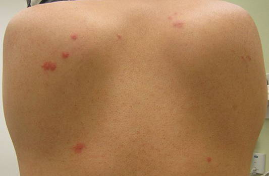 Bed Bug Pest Control Cochrane